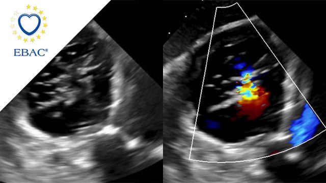 Impact of GDMT on long-term outcome after tricuspid TEER