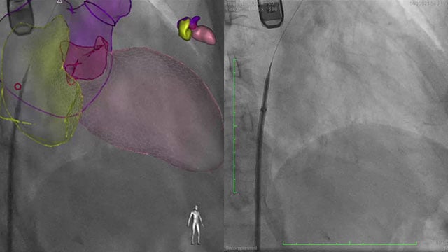LAA closure with CT planning: challenging inferior chicken wing morphology