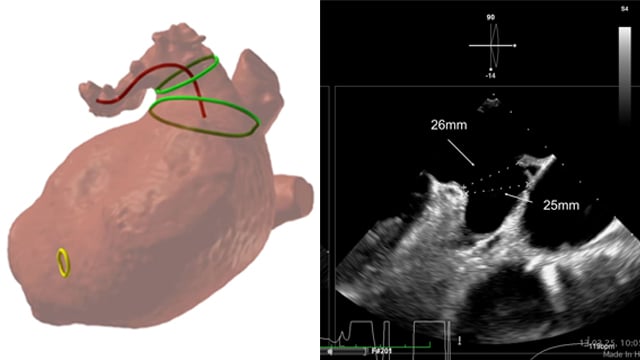 LAA closure with CT planning: challenging inferior chicken wing morphology