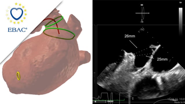 LAA closure with CT planning: challenging inferior chicken wing morphology
