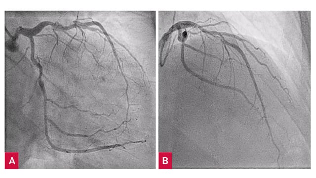 Large thrombus burden management in a young patient with inferior STEMI and multivessel disease