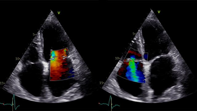 M-TEER with Mitraclip Gen5
