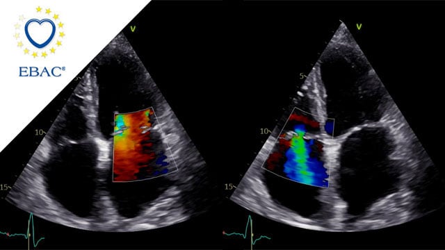M-TEER with Mitraclip Gen5