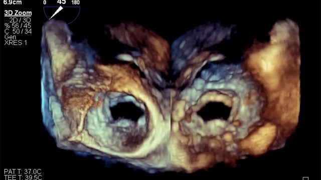 Mixed mitral valve disease in an irradiated chest with eggshell-like left atrium