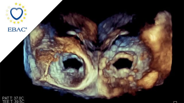 Mixed mitral valve disease in an irradiated chest with eggshell-like left atrium