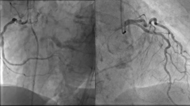 New roads begin where old ones end: a TAVI case