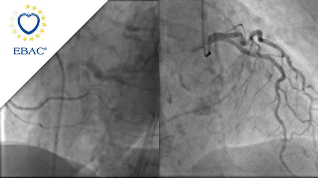 New roads begin where old ones end: a TAVI case