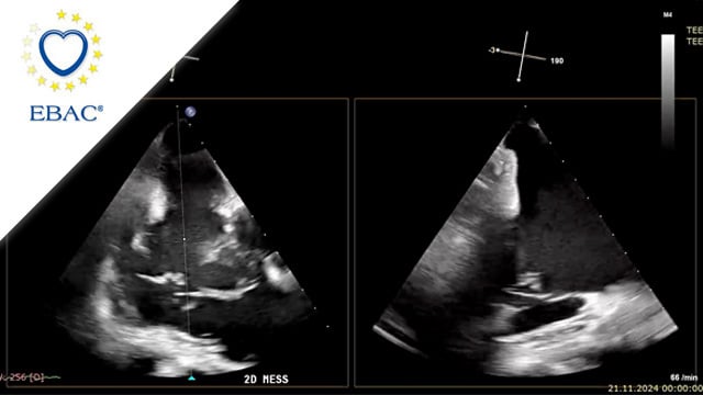 Primary tricuspid regurgitation: how can we avoid high-risk surgery?