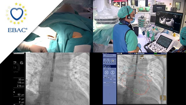 Sealing the risk: a case of left atrial appendage closure