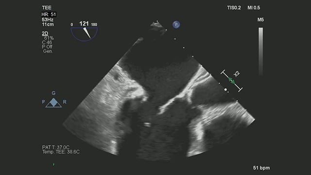 Severe mitral regurgitation in a high-risk patient with a suboptimal anatomy for M-TEER: what other options can we find?