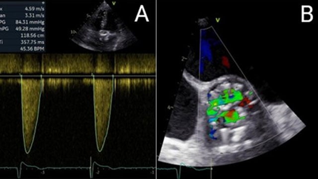 Treating severe restenosis of a 20-mm balloon-expanding valve after a transapical approach with a risk of coronary obstruction