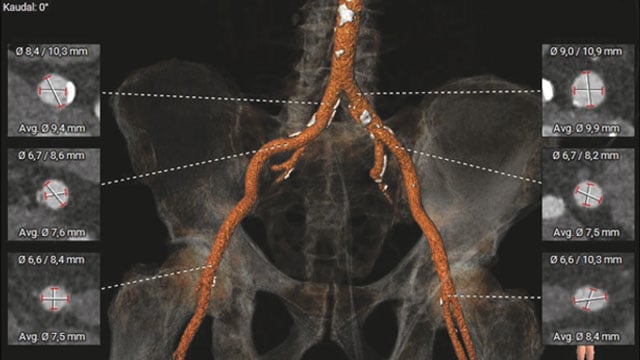 When a surgical valve needs a second life