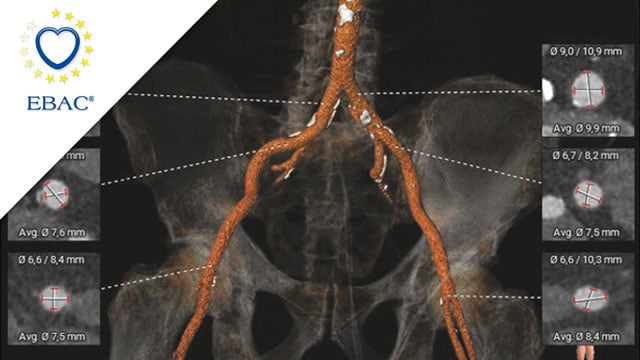 When a surgical valve needs a second life