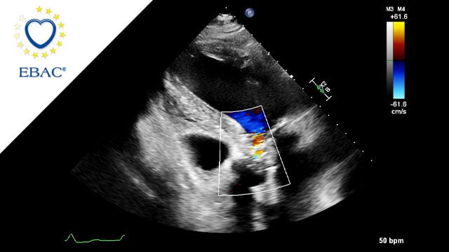 When the first TAVI fails: no panic, just planning