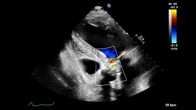 When the first TAVI fails: no panic, just planning