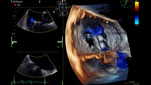 Making the complex simple: bicaval valve implantation as a rescue strategy