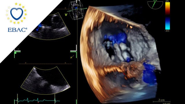 Making the complex Simple: Bicaval Valve Implantation as a Rescue Strategy