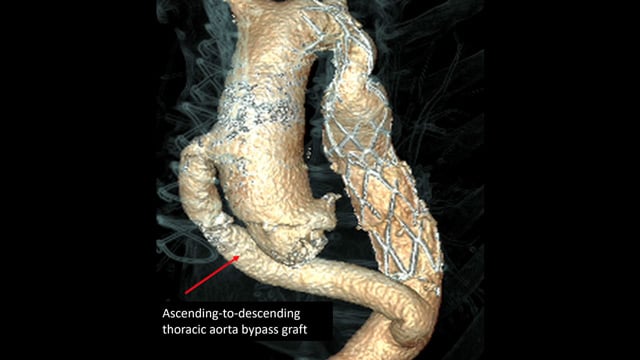 A challenging valve-in-valve scenario in a patient with prior aortic coarctation repair
