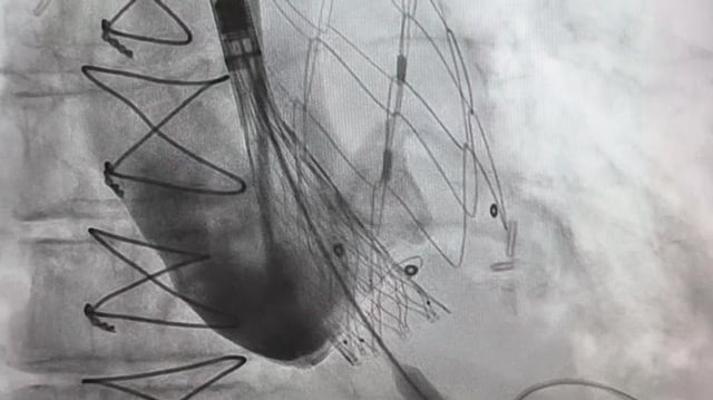 A challenging valve-in-valve scenario in a patient with prior aortic coarctation repair