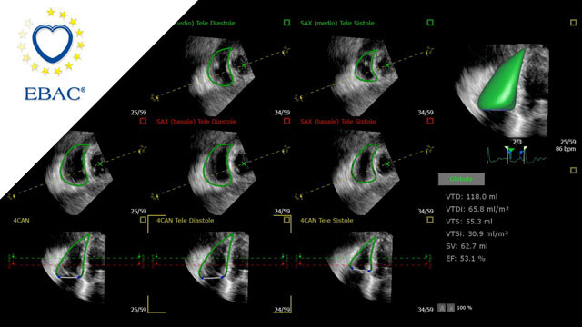 From assessment to strategy: choosing the optimal treatment for severe tricuspid regurgitation