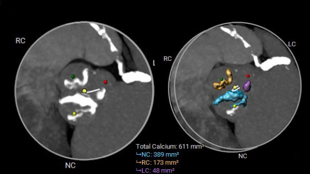 High calcium, high stakes: managing severe AS with complex multivessel disease