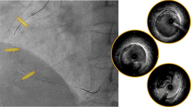 An unconventional pathway to the management of an iatrogenic dissection