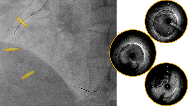An unconventional pathway to the management of an iatrogenic dissection