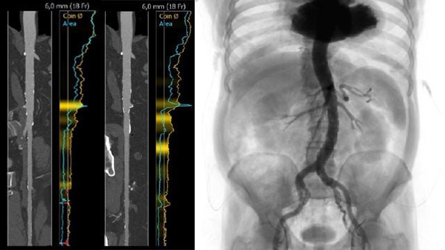 Interdisciplinary therapeutic strategy in a low-risk patient with aortic stenosis and preserved life expectancy