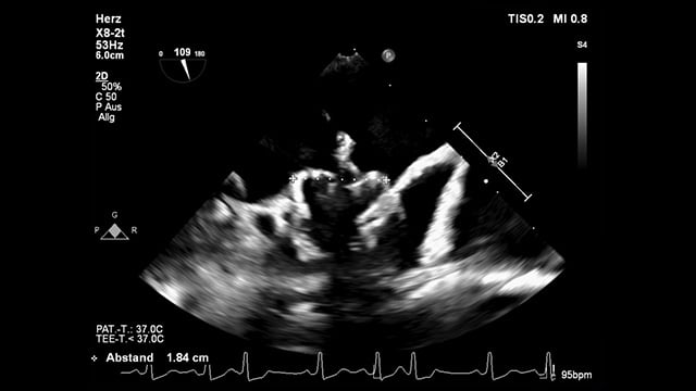 Very small LAA with a challenging closure