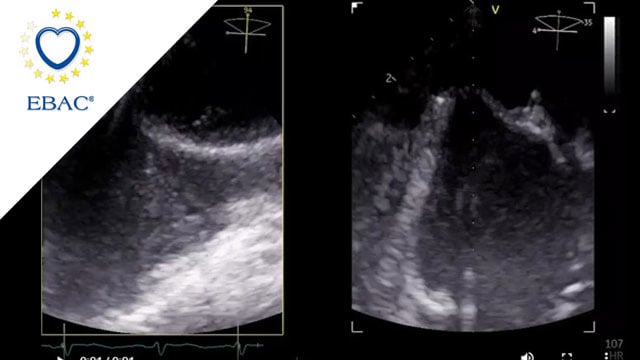 Very small LAA with a challenging closure