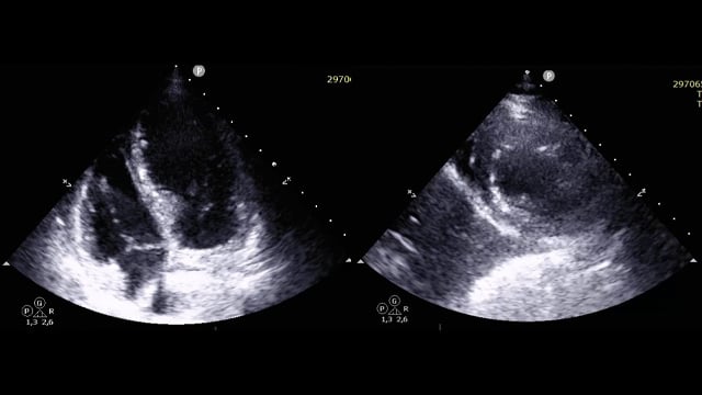 The Future of Aortic Valve Replacement - From Index Procedure to Lifetime Management