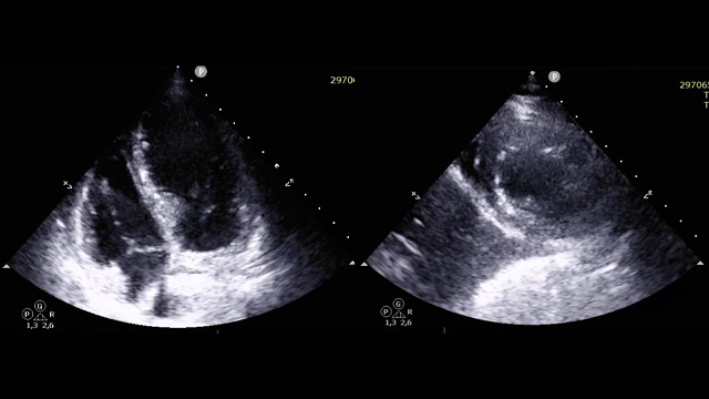The Future of Aortic Valve Replacement - From Index Procedure to Lifetime Management