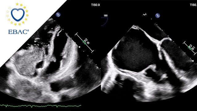 Transcatheter Tricuspid Valve Replacement in Carcinoid Heart Disease: A Multimodality‑Guided, Patient-Centered Approach