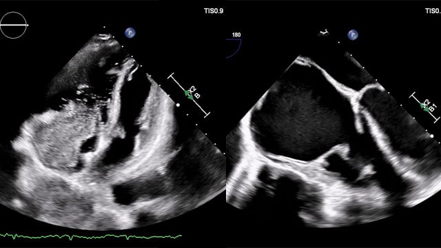 Transcatheter Tricuspid Valve Replacement in Carcinoid Heart Disease: A Multimodality‑Guided, Patient-Centered Approach
