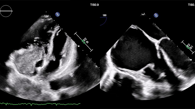 Transcatheter Tricuspid Valve Replacement in Carcinoid Heart Disease: A Multimodality‑Guided, Patient-Centered Approach