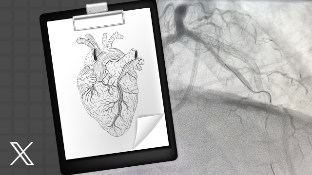 PCI for in-stent restenosis complicated by neoatherosclerosis dissection - teaser image