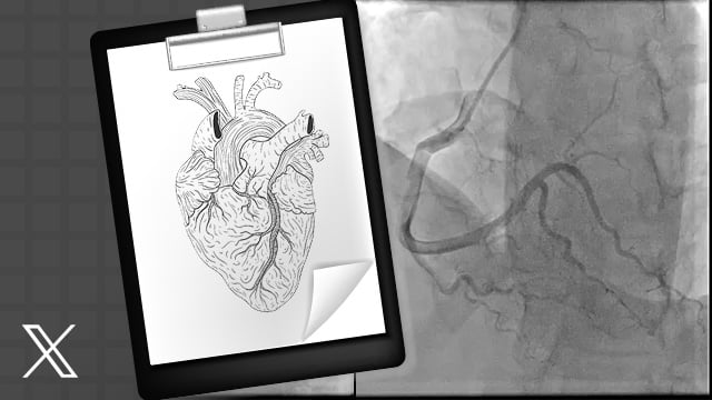 RCA hydrolic dissection: what to do?