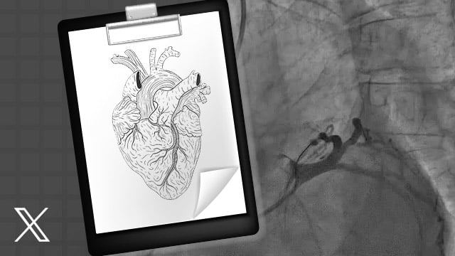 Stepwise OCT for treatment optimization in provisional approach of bifurcated coronary lesions