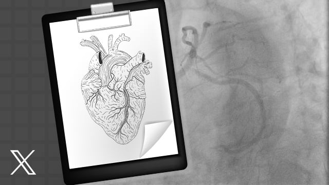 Supplementary super-high pressure balloon-based plaque modification after intravascular lithotripsy