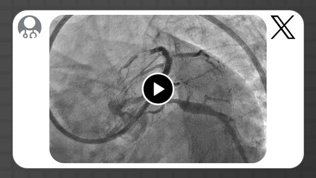 Coronary calcification versus thrombus: a deceptive ambiguity revealed in the aftermath of embolisation