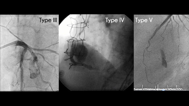 Complications:coronary perforations