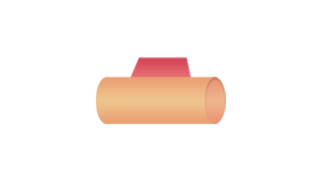 Coronary perforation: Type I
