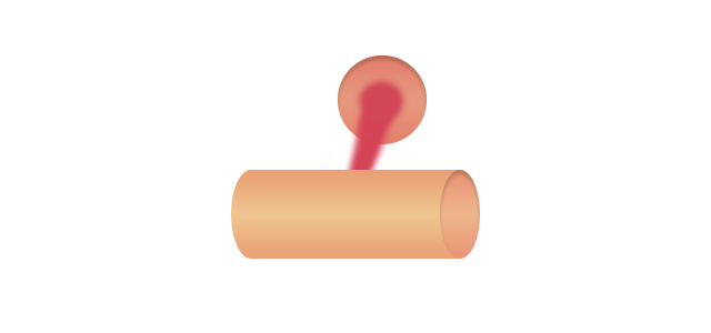 Type IV coronary perforation