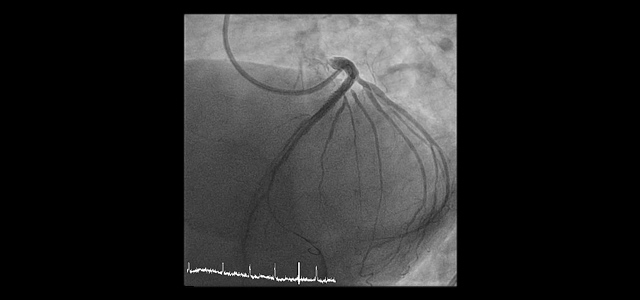 Case study: Thrombin Type IV injection perforation