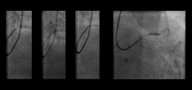 Case study: a calcified LAD Type III perforation