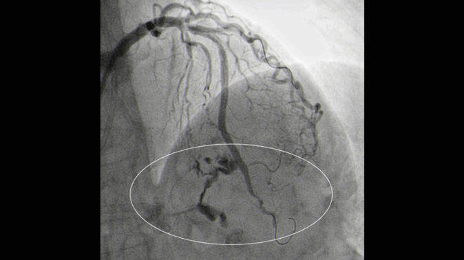 Case study: a coronary Type III perforation during left anterior descending CTO-PCI