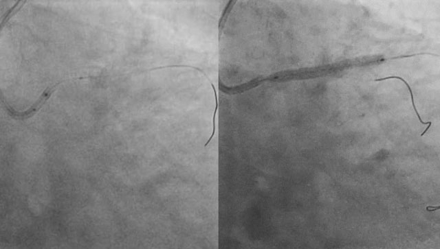 Coronary balloon fracture