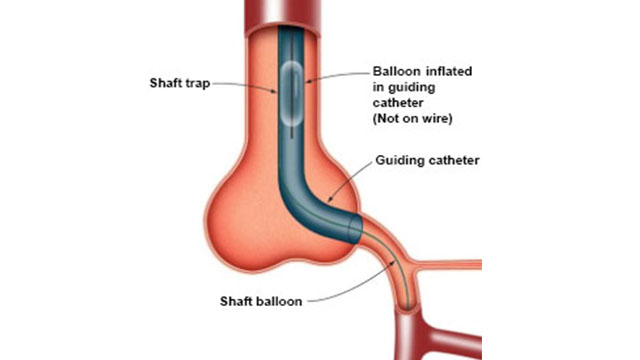 Balloon trapping technique