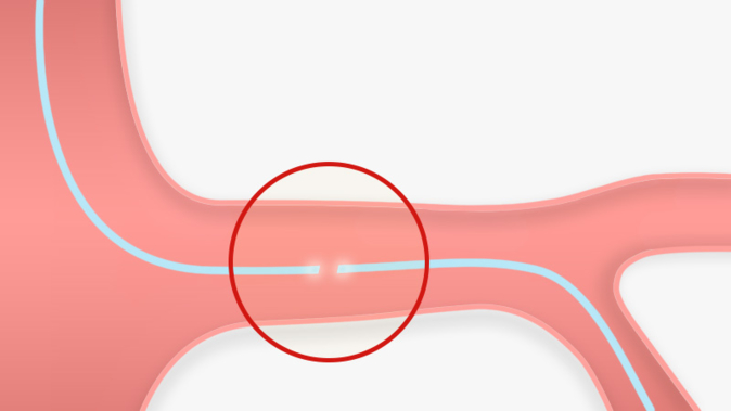 Free intracoronary fractured wire segment