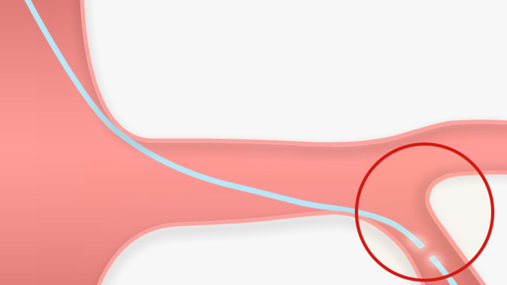 Part of jailed wire behind stent struts: illustration
